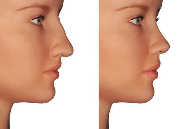 Dr. Rafael Tirapelle - Cirurgia Pl�stica - Rinoplastia - Vaserlipoaspira��o -